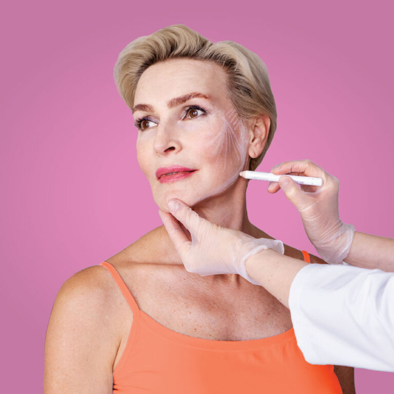 A women being drawn on by a cosmetic surgeon.